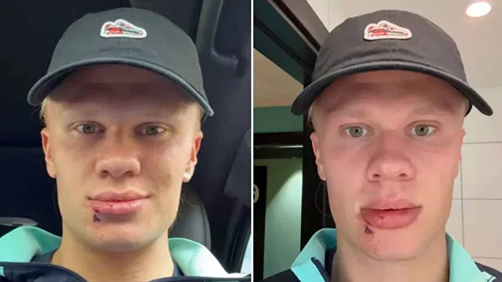 erling haalanddan korkutan sakatlik yuzu taninmaz hale geldi 3 UgDP9isa