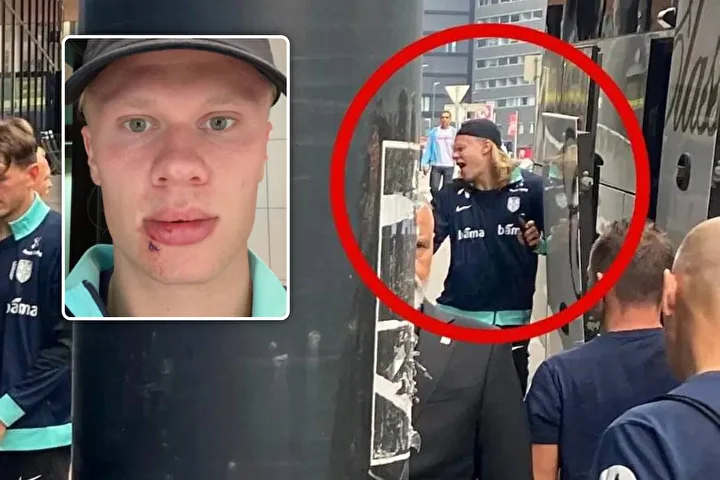 erling haalanddan korkutan sakatlik yuzu taninmaz hale geldi 4 kfmZEljC