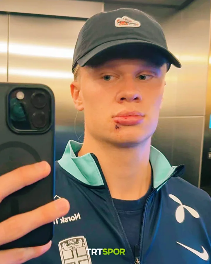 erling haalanddan korkutan sakatlik yuzu taninmaz hale geldi 5 uN6tMXJL