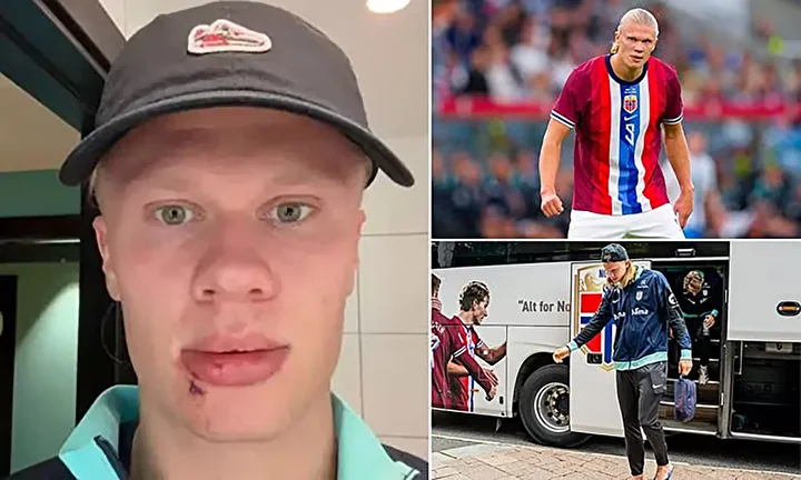 erling haalanddan korkutan sakatlik yuzu taninmaz hale geldi 6 Bn8ckPvi