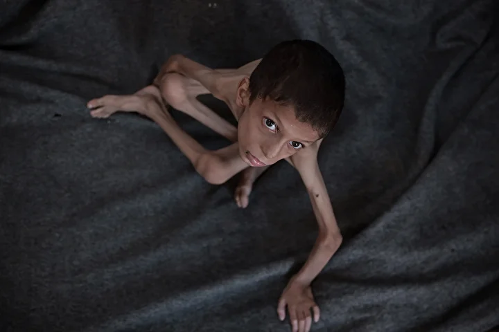 gazzede 10 yasindaki cocuk agir yetersiz beslenme ile karsi karsiya 10