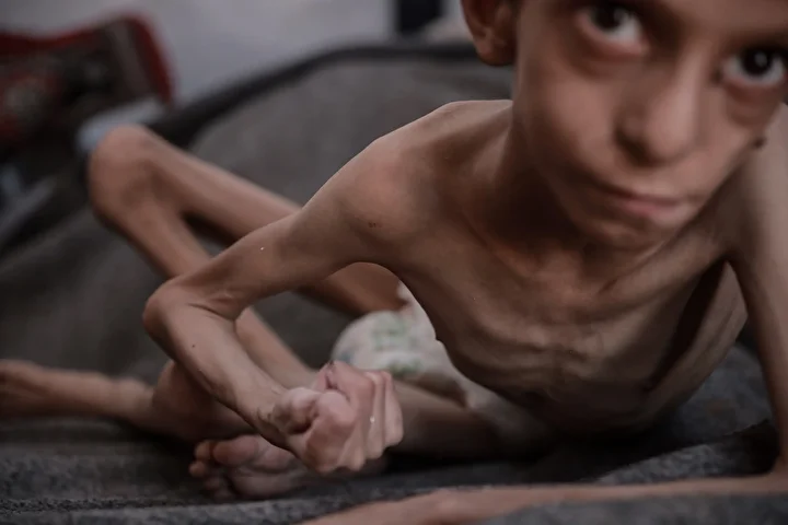 gazzede 10 yasindaki cocuk agir yetersiz beslenme ile karsi karsiya 13 s8LCcMYr