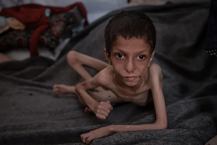 gazzede 10 yasindaki cocuk agir yetersiz beslenme ile karsi karsiya 14 auVJKsVO