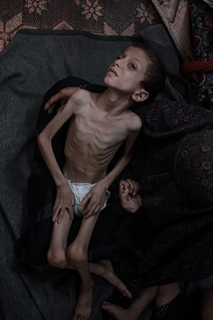 gazzede 10 yasindaki cocuk agir yetersiz beslenme ile karsi karsiya 26 ngi4ap4r