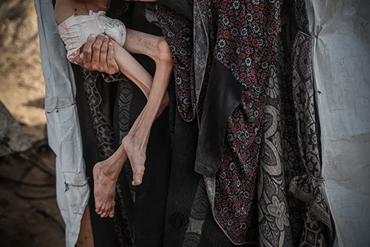 gazzede 10 yasindaki cocuk agir yetersiz beslenme ile karsi karsiya 3 sYR5Ebar