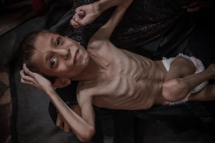 gazzede 10 yasindaki cocuk agir yetersiz beslenme ile karsi karsiya 30 1F3tSUXd