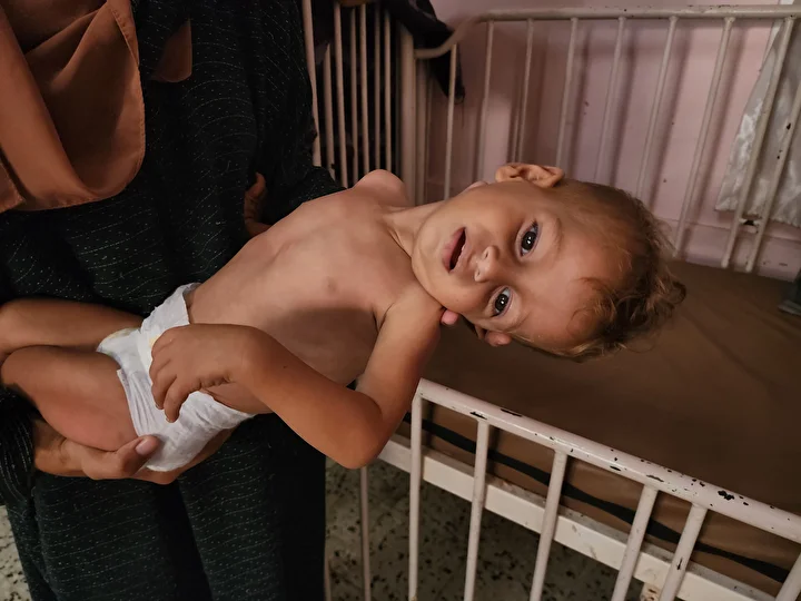 gazzede cocuklarda yetersiz beslenme olaylarinda artis yasaniyor 19 Y7tiJ9D2