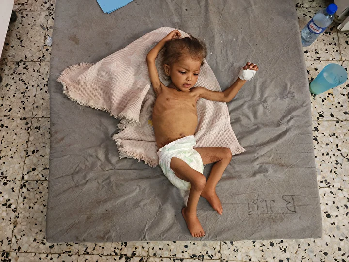 gazzede cocuklarda yetersiz beslenme olaylarinda artis yasaniyor 3 uSJSKAIL