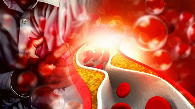 uzmanindan ikaz yuksek ldl kalp krizi ve inme riskini artiriyor ZyIOjUAY.webp