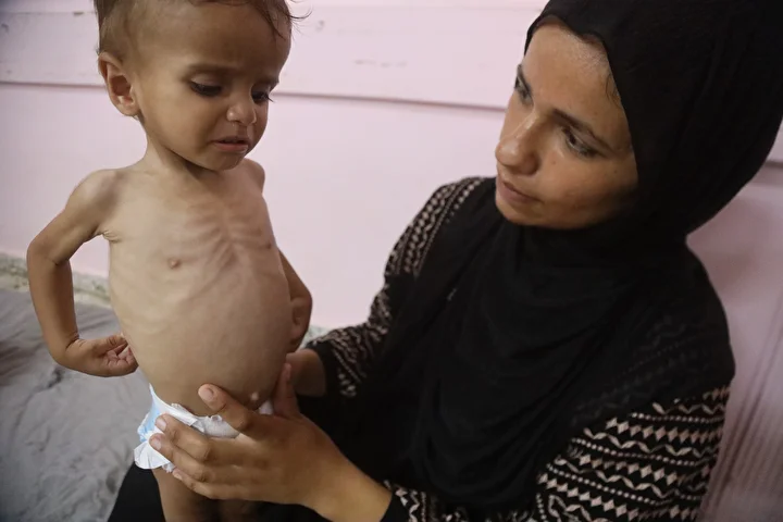 yetersiz beslenme kaynakli can kayiplarinin artiyor gazzede hastanelerdeki cocuklar adeta mevti bekliyor 23 huiP5ePQ