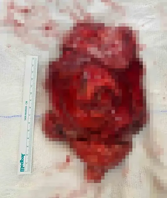 25 milyonda bir goruluyor dev tumor ameliyatla cikarildi 1 BJ78fd4B