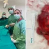 25 milyonda bir goruluyor dev tumor ameliyatla cikarildi zSqZNbBU.webp