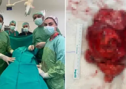25 milyonda bir goruluyor dev tumor ameliyatla cikarildi zSqZNbBU.webp