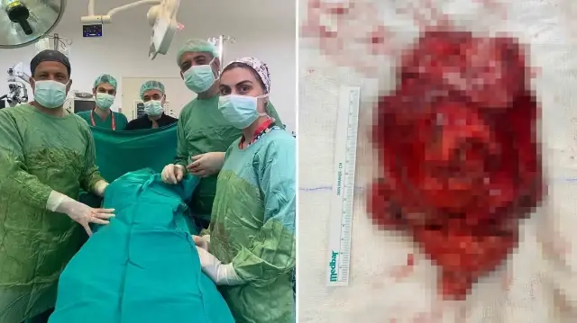 25 milyonda bir goruluyor dev tumor ameliyatla cikarildi zSqZNbBU.webp