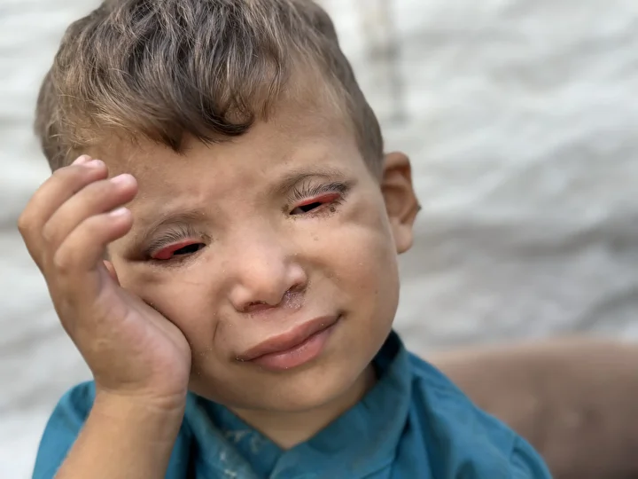 İsrail'in kıtlığa sürüklediği Gazze'de 'Göz kapağı' hastası 10 yaşındaki Ramez'in durumu yürek burkuyor 1 israilin kitliga surukledigi gazzede goz kapagi hastasi 10 yasindaki ramezin durumu yurek burkuyor 0