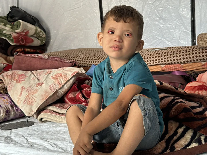 İsrail'in kıtlığa sürüklediği Gazze'de 'Göz kapağı' hastası 10 yaşındaki Ramez'in durumu yürek burkuyor 11 israilin kitliga surukledigi gazzede goz kapagi hastasi 10 yasindaki ramezin durumu yurek burkuyor 10 QCd9E4VB