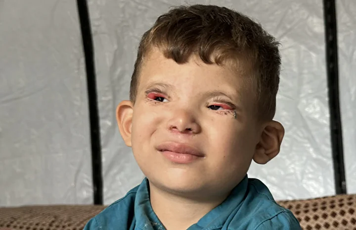İsrail'in kıtlığa sürüklediği Gazze'de 'Göz kapağı' hastası 10 yaşındaki Ramez'in durumu yürek burkuyor 6 israilin kitliga surukledigi gazzede goz kapagi hastasi 10 yasindaki ramezin durumu yurek burkuyor 5 LnnPWuqM