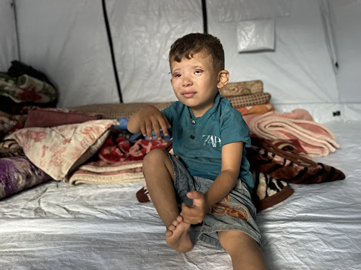 İsrail'in kıtlığa sürüklediği Gazze'de 'Göz kapağı' hastası 10 yaşındaki Ramez'in durumu yürek burkuyor 8 israilin kitliga surukledigi gazzede goz kapagi hastasi 10 yasindaki ramezin durumu yurek burkuyor 7 bA6irMDE