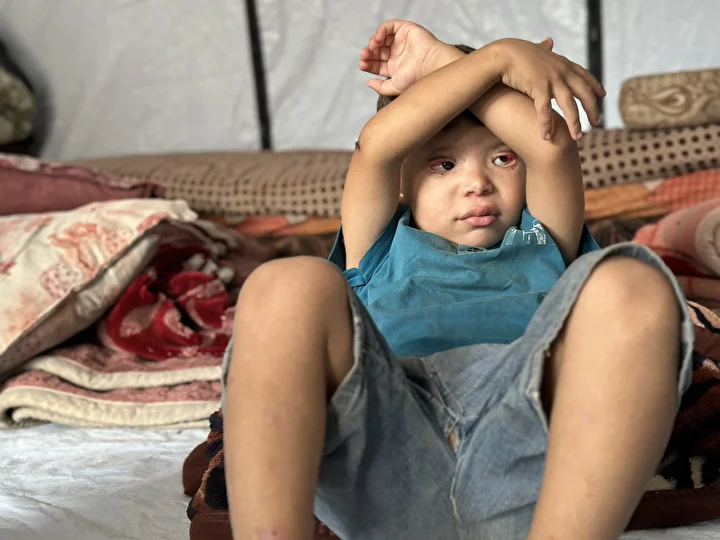 İsrail'in kıtlığa sürüklediği Gazze'de 'Göz kapağı' hastası 10 yaşındaki Ramez'in durumu yürek burkuyor 10 israilin kitliga surukledigi gazzede goz kapagi hastasi 10 yasindaki ramezin durumu yurek burkuyor 9 n9ByvLA6
