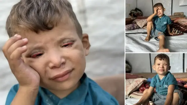 İsrail’in kıtlığa sürüklediği Gazze’de ‘Göz kapağı’ hastası 10 yaşındaki Ramez’in durumu yürek burkuyor israilin kitliga surukledigi gazzede goz kapagi hastasi 10 yasindaki ramezin durumu yurek burkuyor DvqQ13Dl.webp