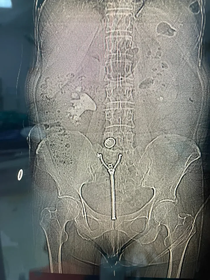 Organını büsbütün dolduran 8 santimetrelik 'geyik boynuzu' böbrek taşı ameliyatla çıkarıldı 3 organini busbutun dolduran 8 santimetrelik geyik boynuzu bobrek tasi ameliyatla cikarildi 2