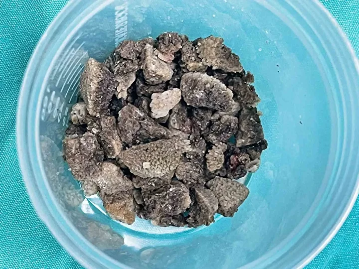 Organını büsbütün dolduran 8 santimetrelik 'geyik boynuzu' böbrek taşı ameliyatla çıkarıldı 4 organini busbutun dolduran 8 santimetrelik geyik boynuzu bobrek tasi ameliyatla cikarildi 3
