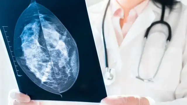 uzmanlar 40 yasindan sonra her bayana mamografi takibi oneriyor Q4zslzDM.webp