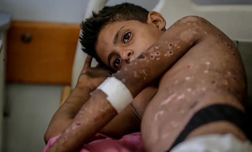 gazzede patlamamis muhimmat infilak etmesi iki cocugu agir yaraladi 2 aysOYM1u