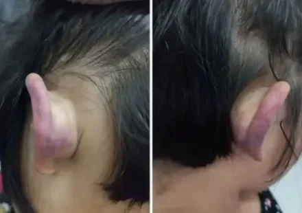 Küçük kızın kulak ağrısının altından çıkan gerçek tüyler ürpertti kucuk kizin kulak agrisinin altindan cikan gercek tuyler urpertti 55NjdMS9.webp